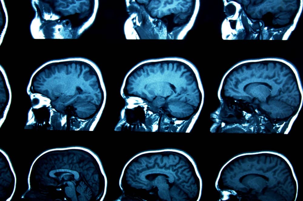 Transient Ischemic Attack: Signs & Treatment | Medical Park