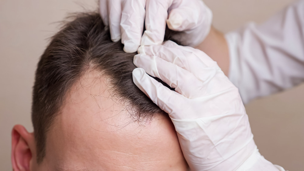 Stem Cell Hair Transplant in Turkey